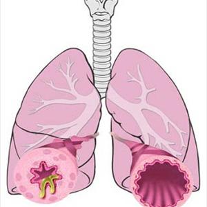Lung Pain When C - Learn To Treat Bronchitis Naturally In Seven Days