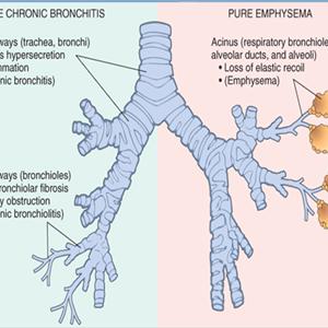  Home Remedies And Symptoms Regarding Bronchitis