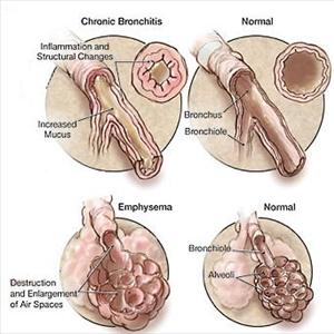 Stopping Bronchitis Coughing - Popcorn Lung