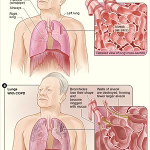 Bronchitis That Will N - Alternative Emphysema Treatment