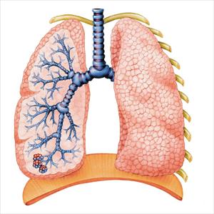 Chronic Obstructive Bronchitis - How Can A Lung Cleanse Help Smokers?