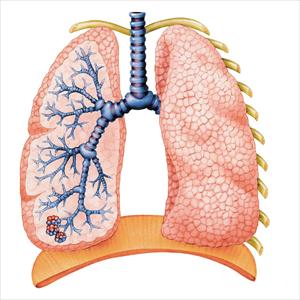 Chronic Obstructive Bronchitis 