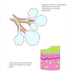 Tgt-Index - Bronchitis Inside A Pregnant Mother