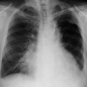Emphysema Cures - Useful Pointers In Looking For Treating Longterm Bronchitis