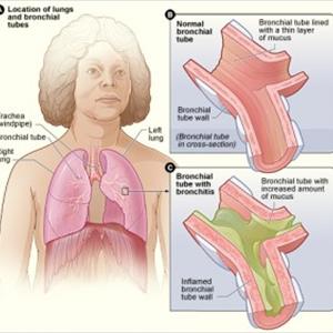  Bronchitis Business And Information To Manage This Kind Of Disorder