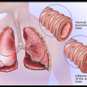 Cronic Bronchitis Cough - Are E Cigarettes Safer Than Regular Cigarettes?