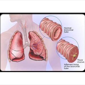 Allergy And Pain In Lungs - Homeopathic Medicines In The Treatment Of Bronchitis