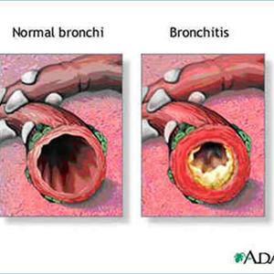  Bronchitis 