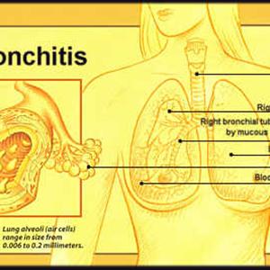  The General See And Medical Explanation Of Bronchiectasis