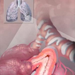 Puffers For Bronchitis - Bronchitis Organization And Information To Manage This Disorder