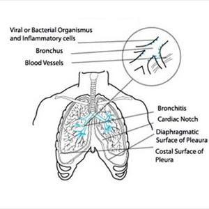 Nagging Cough With Mucus - Lung Infections