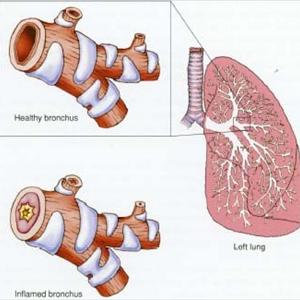 Chronic Bronchitis Remedies - Common Remedies To Be Able To Fight Bronchitis