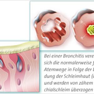 Fastest Way To Heal Bronchitis - Bronchitis - Brings About As Well As Home Remedies