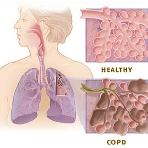 Hand Therapy To Treat Bronchiectasis - Is Bronchitis Contagious?