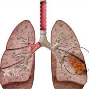 Bronchial Pain - Breast Biopsy