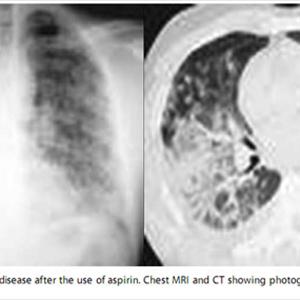  Some Things Good To Know About Bronchitis