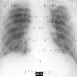  How Is Actually Bronchitis Treated?