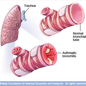 Drug For Chronic Bronchitis 