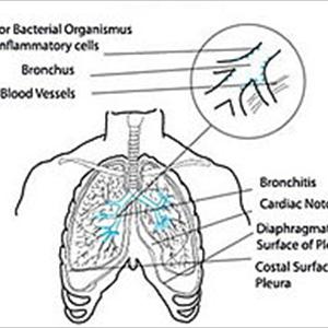 Buy Bronovil Remedy - Bronchitis Pictures